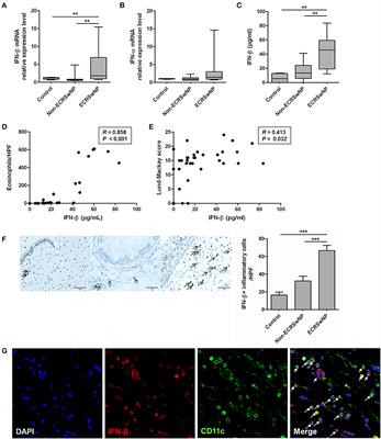 Enhanced Interferon-β Response Contributes to Eosinophilic Chronic Rhinosinusitis